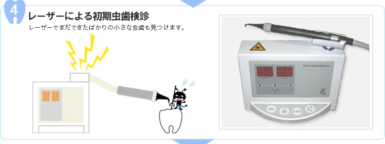 4.レーザーによる初期虫歯検診